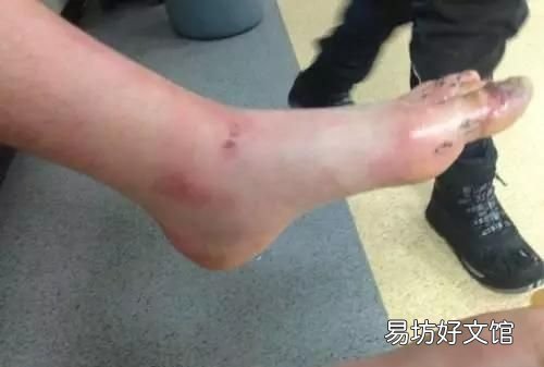 脚得了冻疮怎么办