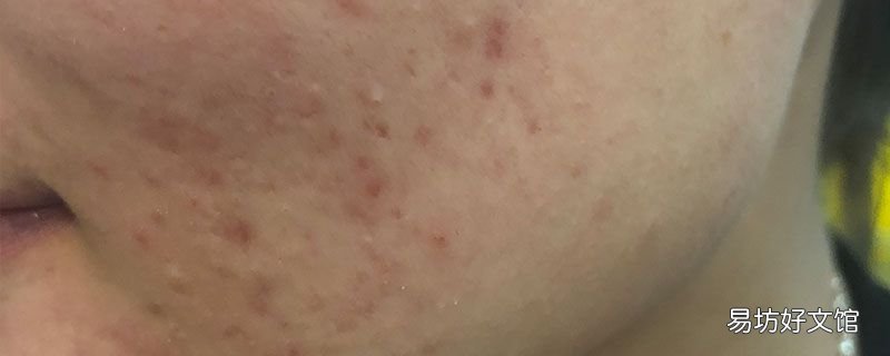 活性斑和定性斑的区别