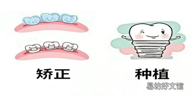 镶牙怎么选择最适合你的方式