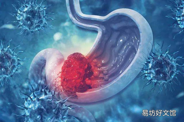 什么是 “皮革胃”和“印戒细胞癌”?