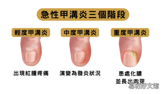 反反复复甲沟炎,或许和一些不起眼的小动作有关~