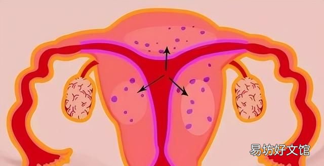 女性查出子宫肌瘤,哪些食物不建议多吃呢