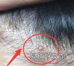 怎么有效的除螨 如何有效的除螨面部