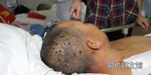 被马蜂蛰了怎么办小妙招 在外被马蜂蛰了怎么办消肿止痛