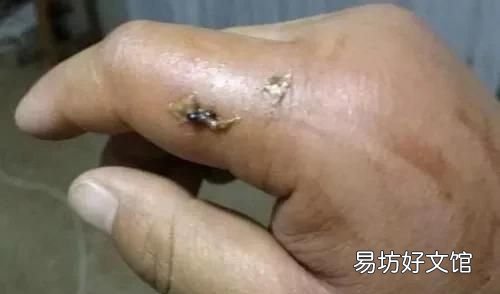 被马蜂蛰了怎么办小妙招 在外被马蜂蛰了怎么办消肿止痛