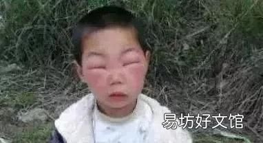 被马蜂蛰了怎么办小妙招 在外被马蜂蛰了怎么办消肿止痛