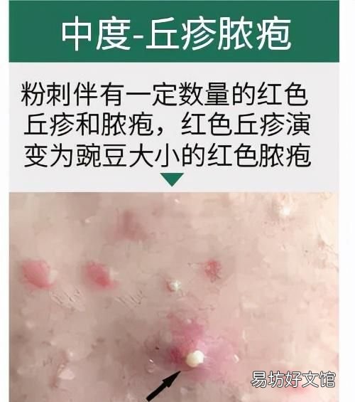 怎么治疗青春痘痤疮，怎么治疗青春痘痤疮