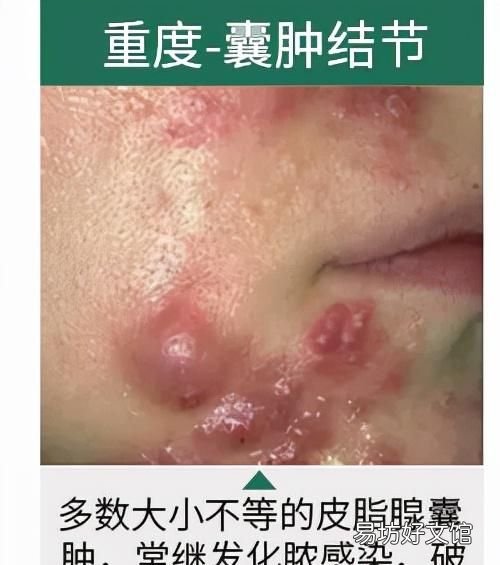怎么治疗青春痘痤疮，怎么治疗青春痘痤疮