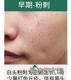 怎么治疗青春痘痤疮，怎么治疗青春痘痤疮