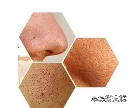 毛孔特别粗大 毛孔粗大怎么办?