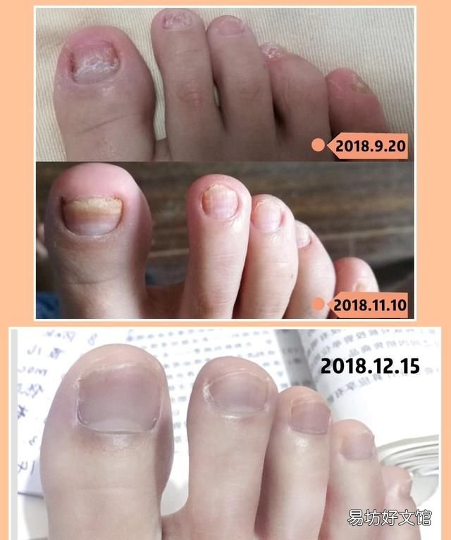 灰指甲是一种具有传染性的病 指甲油能托运吗