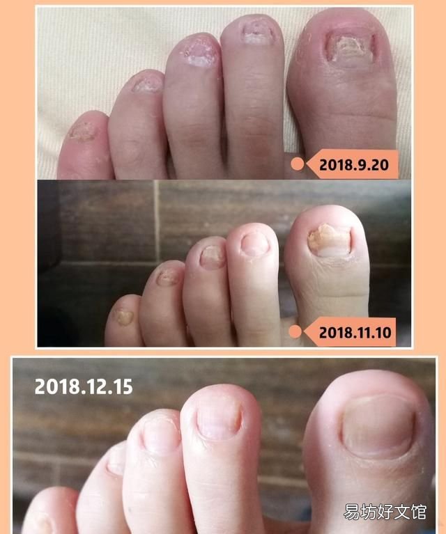灰指甲是一种具有传染性的病 指甲油能托运吗