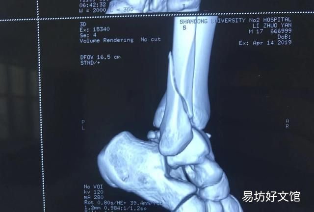 脚崴了怎么处理,脚崴了怎么快速恢复消肿