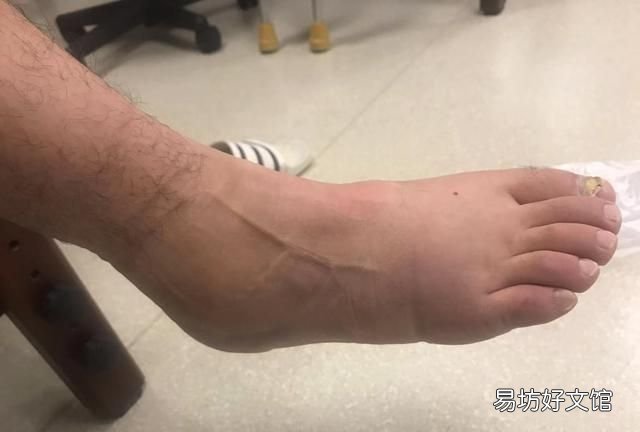 脚崴了怎么处理,脚崴了怎么快速恢复消肿