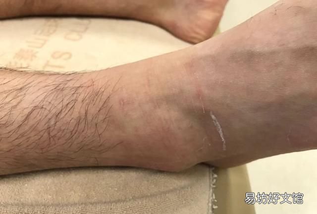 脚崴了怎么处理,脚崴了怎么快速恢复消肿