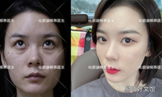 怎么去眼袋？不开刀怎么去眼袋呢？