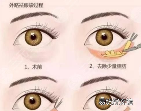 怎么去眼袋？不开刀怎么去眼袋呢？