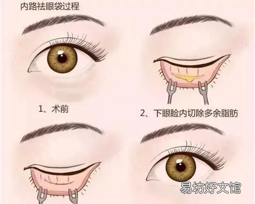 怎么去眼袋？不开刀怎么去眼袋呢？