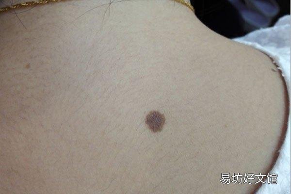 一览身体6种异常的痣 不正常痣的样子图片大全