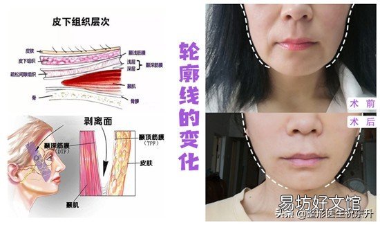 全面介绍法令纹形成原因及消除方法 什么是法令纹图片