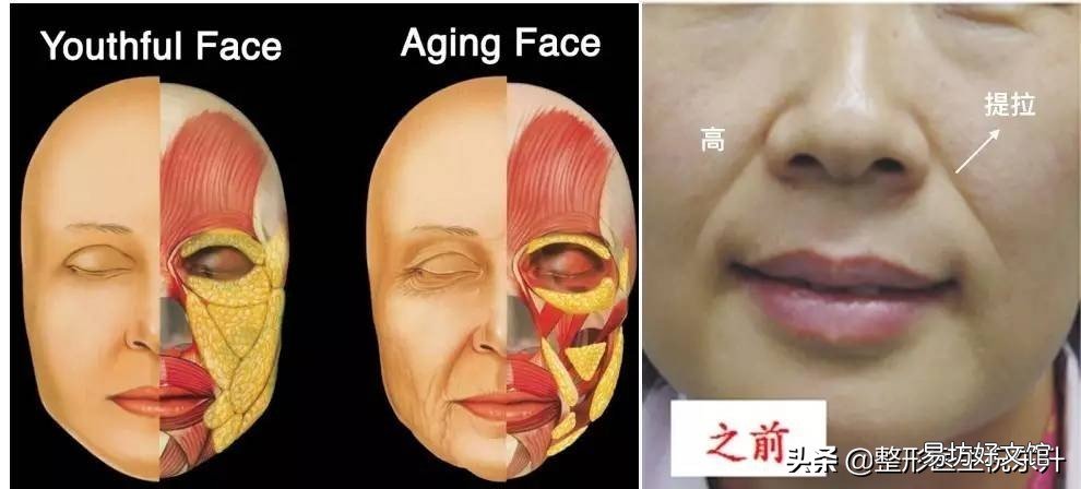 全面介绍法令纹形成原因及消除方法 什么是法令纹图片