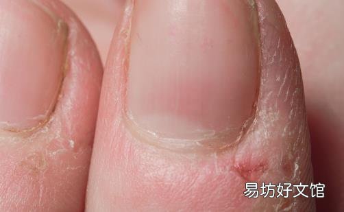 冬天手指周围总是长倒刺 到底是不是缺乏维生素