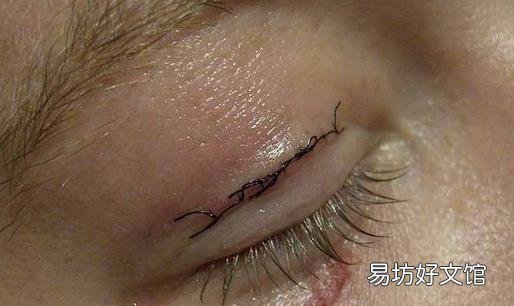 你真的适合做双眼皮术吗