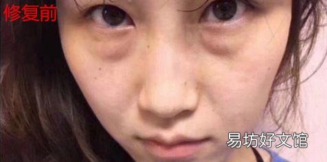 君雅笔记：眼袋过重，就会显得比真实年龄大，要如何修复眼袋呢？