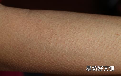 皮肤不平整总起鸡皮疙瘩 教你消鸡皮让皮肤恢复光滑