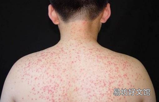 皮肤不平整总起鸡皮疙瘩 教你消鸡皮让皮肤恢复光滑