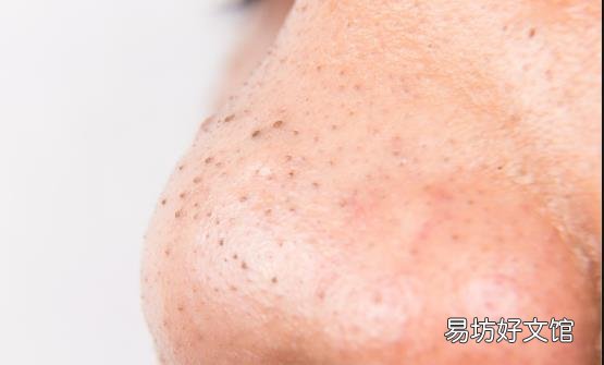 草莓鼻真的很难看影响美观 形成草莓鼻的常见原因