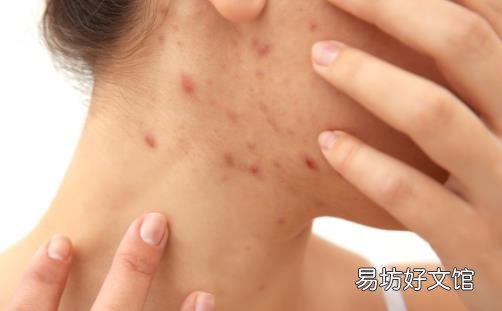 皮炎轻松解决方法 皮炎人群的日常护理法则