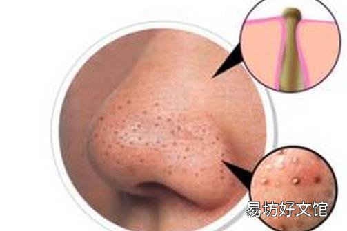 患有草莓鼻怎么办 几招帮你恢复细致毛孔