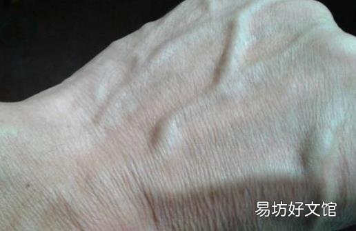 手上青筋说明身体有湿气 不同部位青筋显示不同问题