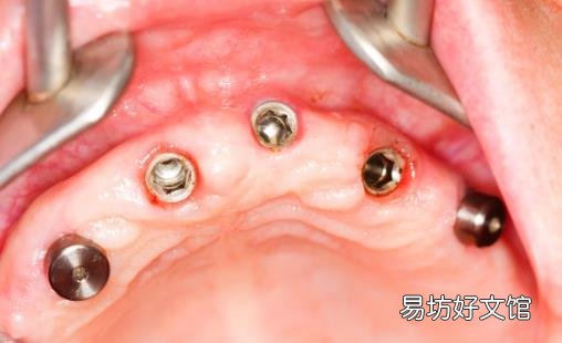种一口牙相当于买辆宝马 种植牙的有关护理事项