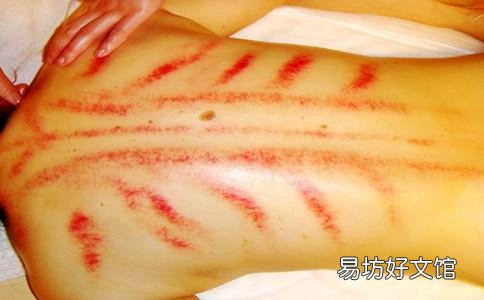 中医刮痧要谨慎而行 哪些人不适合刮痧?