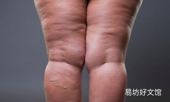 总是吃太咸的食物易引发水肿 吃得太咸还会引发什么疾病