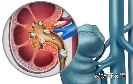 六类食物吃多了易得肾结石 预防肾结石食疗方推荐