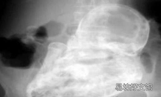 太吓人，82岁老太太查出竟怀孕40年