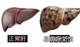 脂肪肝肝硬化怎么办 脂肪肝肝硬化怎么办啊