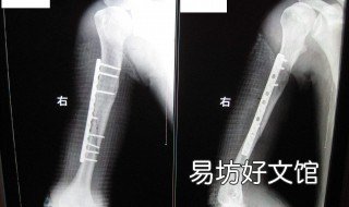 骨折打鋼釘幾級工傷 打鋼釘幾級傷殘