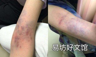 胳膊腕拍打发黑是什么原因 一拍胳膊腕都是黑疙瘩
