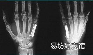 骨折三周后能做手术吗 骨折三个月后才动手术