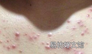 内分泌失调长痘痘 内分泌失调长痘痘吃什么药调理