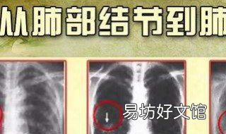 肺结节拍打方法 肺结节诊断怎么打