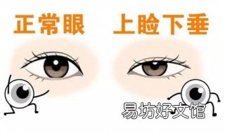 上睑下垂怎么办 上睑下垂怎么办才能恢复