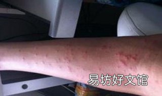 慢性荨麻疹不能吃什么 慢性荨麻疹不能吃什么类型的消炎止痛药