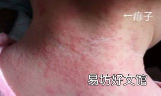 孩子起痱子怎么办 孩子起痱子怎么办视频