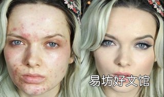 满脸青春痘怎么办 满脸的青春痘咋办
