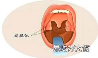 扁桃体有炎症怎么办 扁桃体发炎怎么办